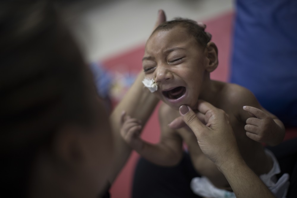 Estudo reforça relação entre zika e anomalias em olhos de bebês